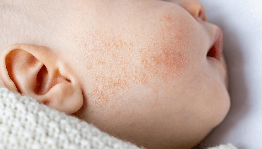 Bebé con acné